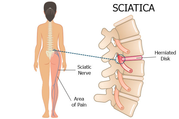 what causes sciatica