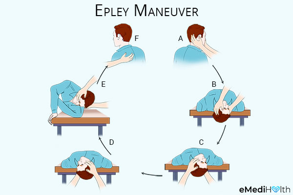 performing epley maneuver can help reduce vertigo