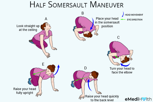 performing half somersault maneuver can help reduce vertigo