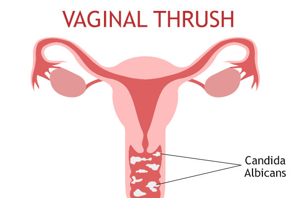 what are the reasons behind vaginal thrush?