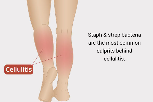 what causes cellulitis?