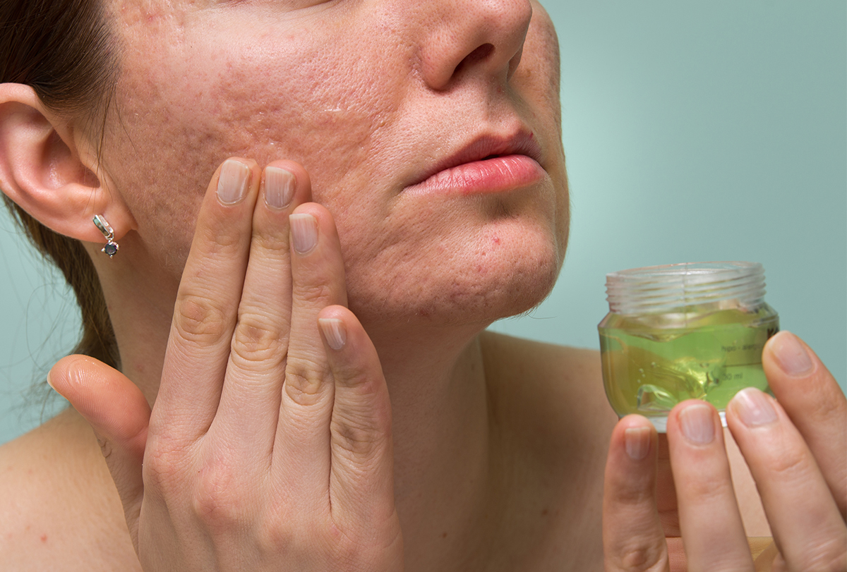 at-home remedies to fade scars