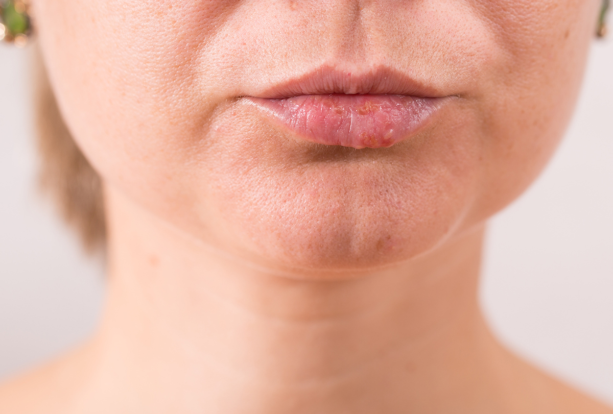 treating white bumps on lips