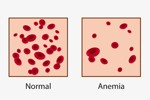 different types of anemia