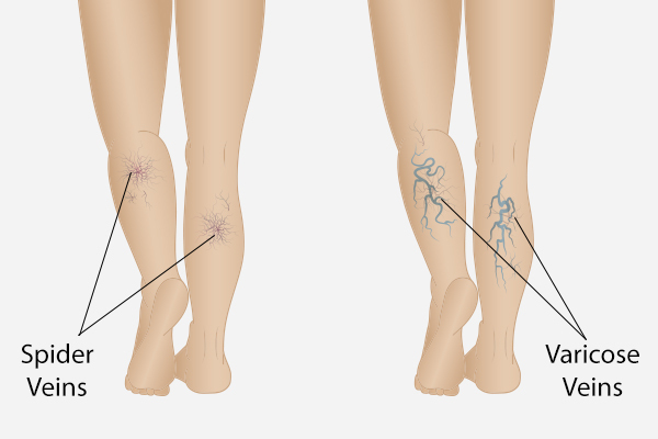 differences between spider veins and varicose veins