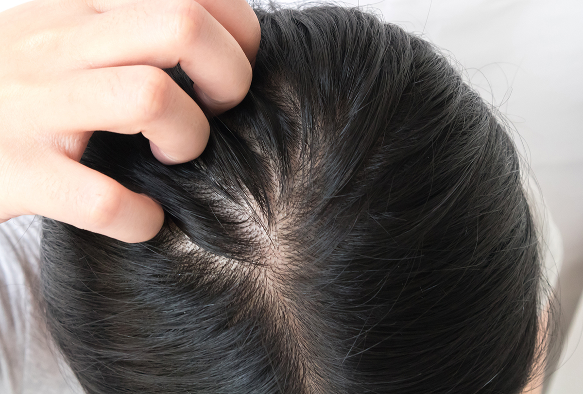 treating itchy scalp