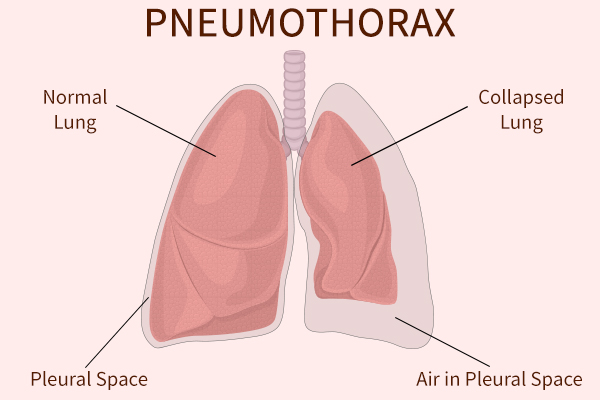 causes of pneumothorax