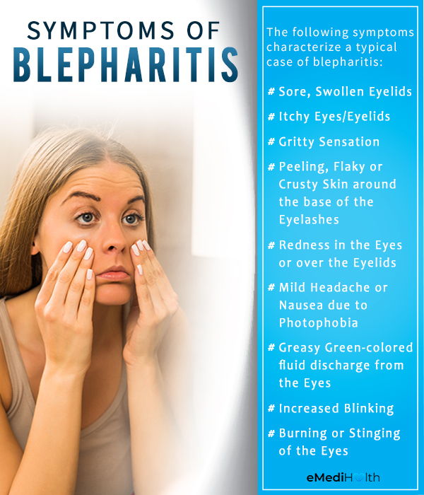 symptoms of blepharitis
