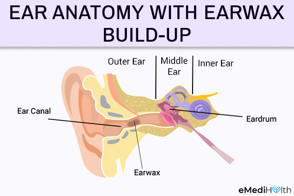 how does earwax accumulate inside the ear canal? 