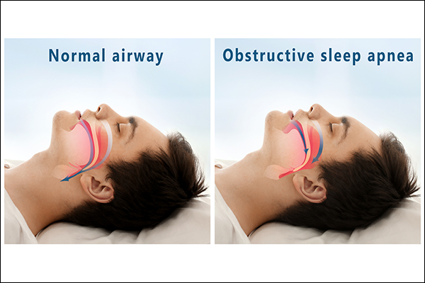 obstructive sleep apnea is most common and can be fatal
