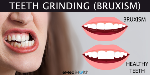 how is bruxism diagnosed?