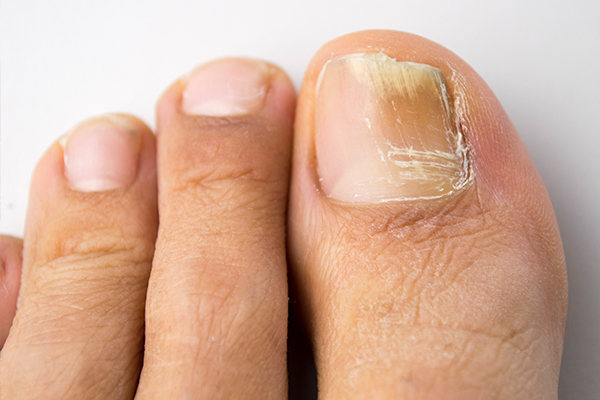 complications associated with athlete's foot
