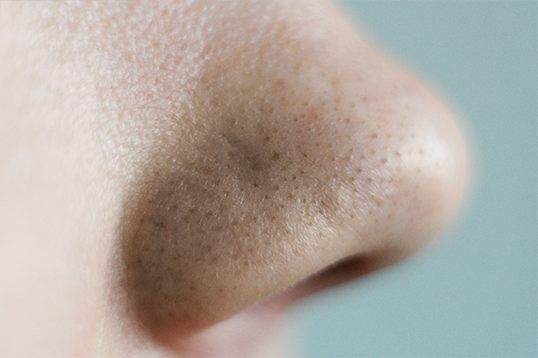 expert opinions on blackheads