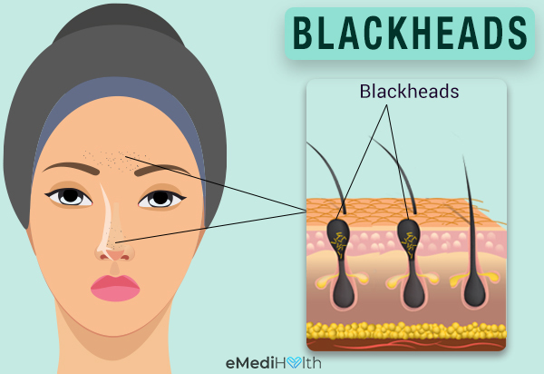 what leads to the formation of blackheads?
