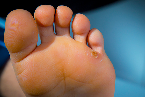 complications of untreated bunions