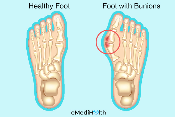 how prevalent is bunion pain?