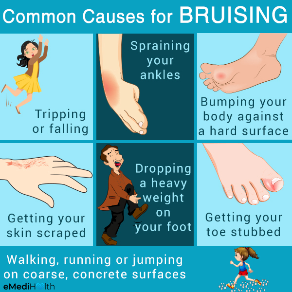 what are the causes behind bruising?