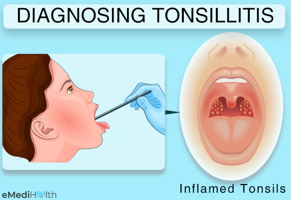 how is tonsillitis diagnosed?