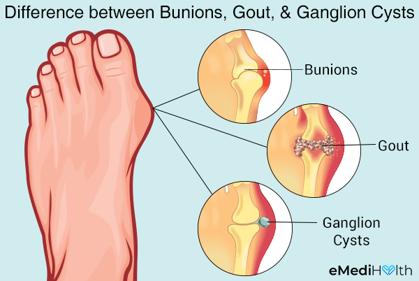 other foot conditions often confused with bunions