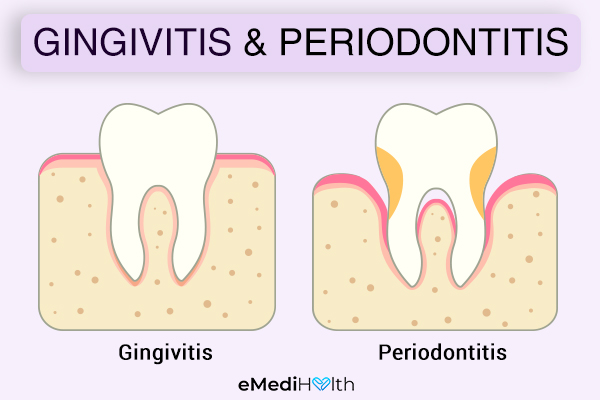are gingivitis and periodontitis the same?