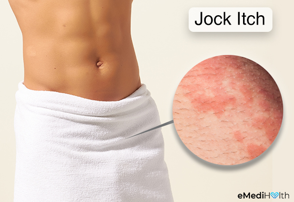 symptoms that indicate a jock itch