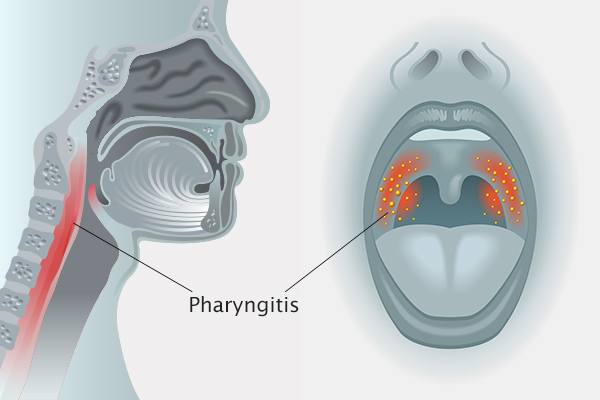 what causes pharyngitis?