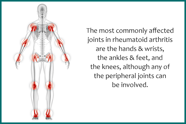 most commonly affected joints in rheumatoid arthritis