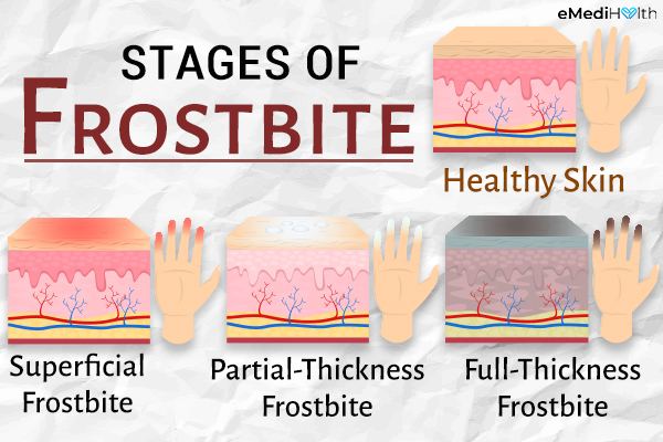 stages of frostbite