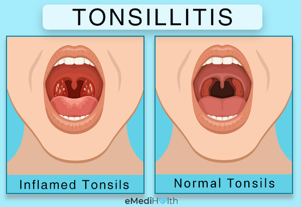 how to check for tonsillitis