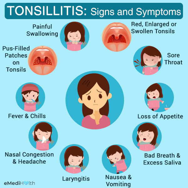 signs and symptoms that suggest tonsillitis