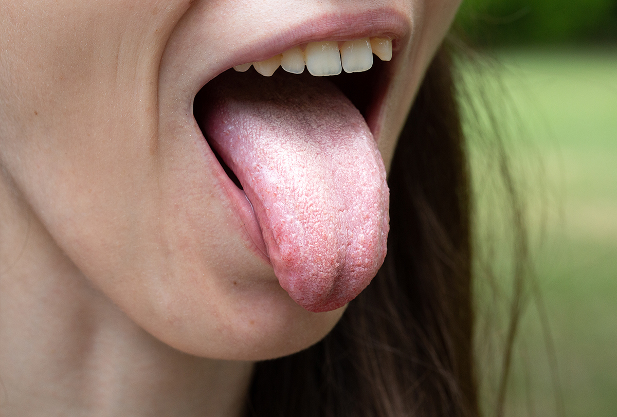 reasons for a white tongue