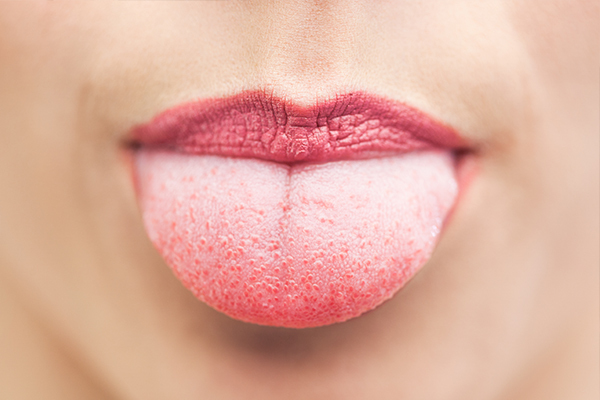 experts advice on dealing with a white tongue