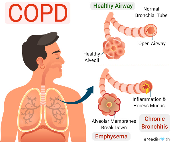 what are the causes behind copd?