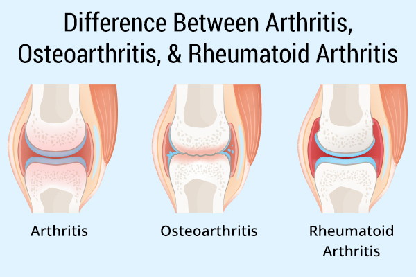 differences between different kinds of arthritis