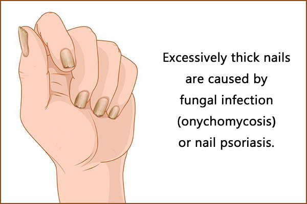 excessively thick nails causes