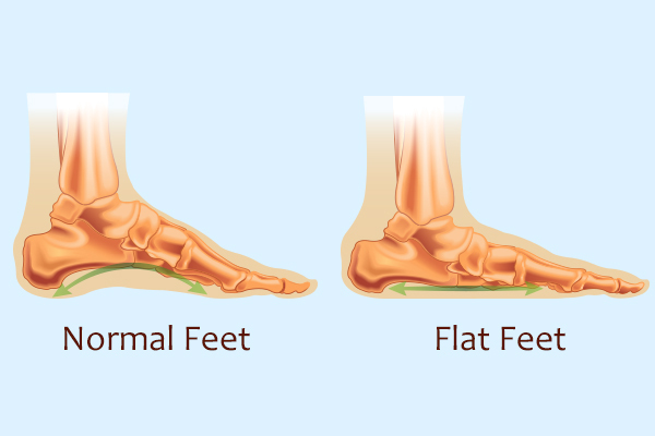 complications that accompany a flatfoot