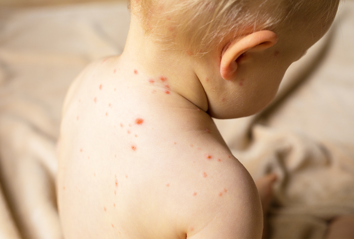 home treatment for measles