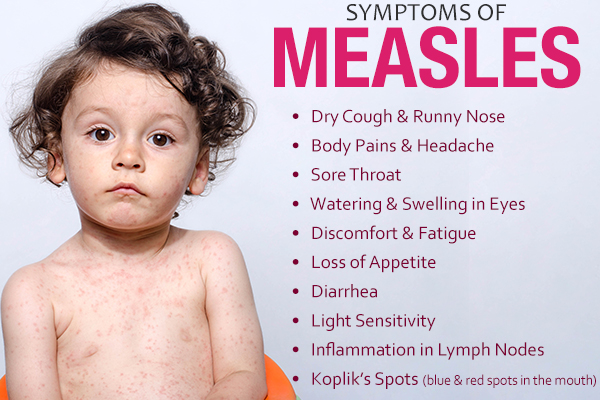 signs and symptoms that accompany measles