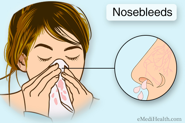prevalence of nosebleeds