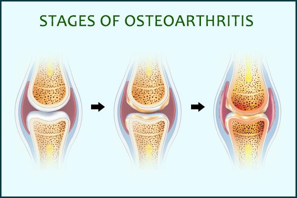 stages of osteoarthritis progression