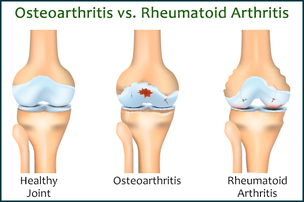 osteoarthritis versus rheumatoid arthritis