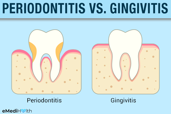 periodontitis versus gingivitis