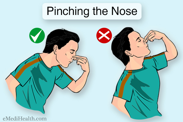 pinching the nose can help stop a regular nosebleed