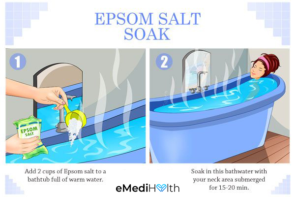 taking an Epsom salt bath can help soothe psoriasis