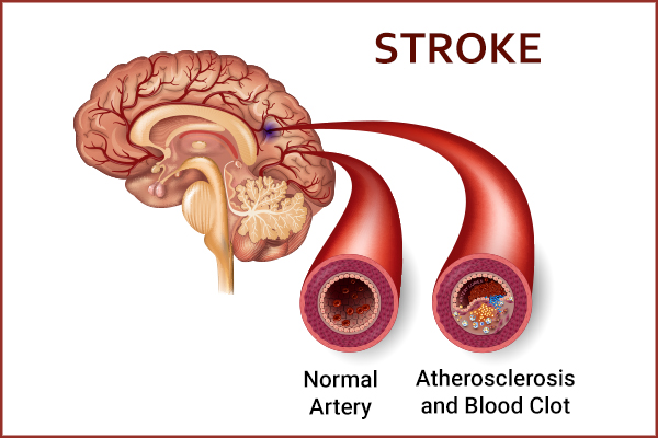 efficacy of blood thinners in stroke prevention