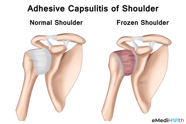 what causes a frozen shoulder?