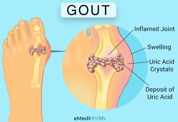 tissues affected by gout