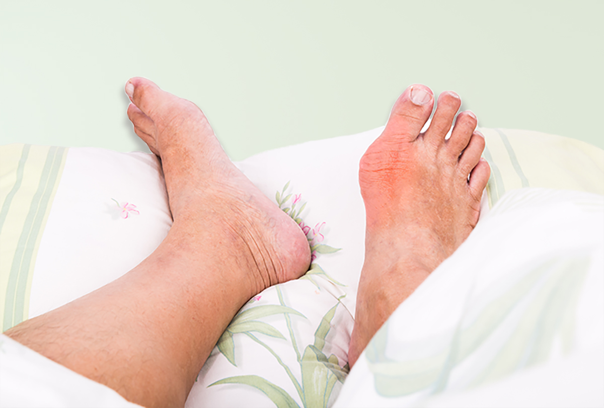 at-home remedies to manage gout