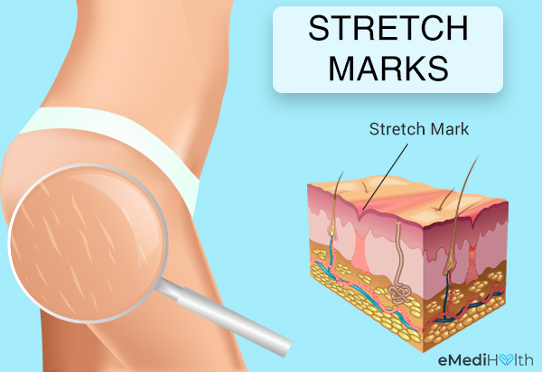 stretch marks: appearance and texture