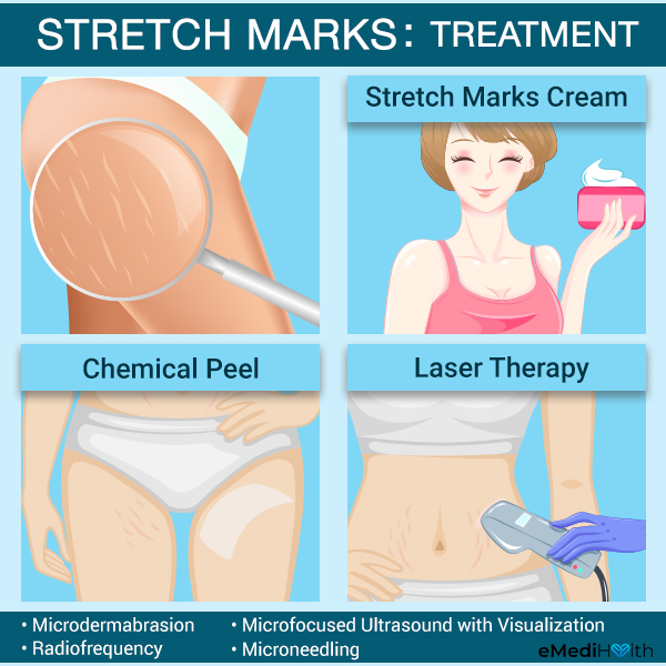 how to treat stretch marks?